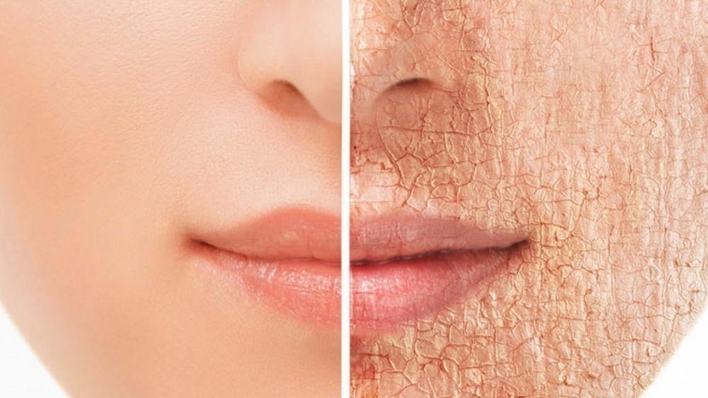 CREMA PARA RESEQUEDAD CON UREA