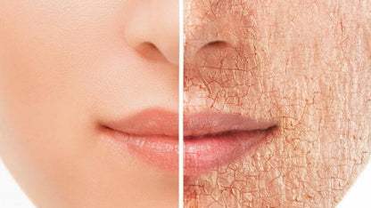 CREMA PARA RESEQUEDAD CON UREA